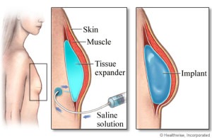 tissue-expander-breast-reconstruction