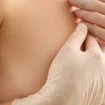 breast implant to autologous reconstruction
