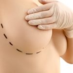 converting to prepectoral breast reconstruction