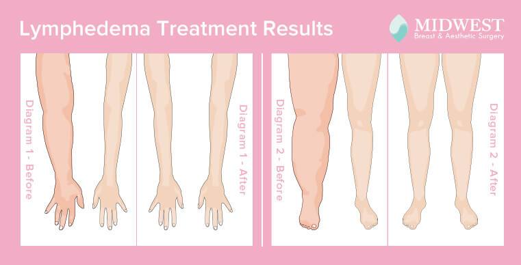 lymphedema treatment results