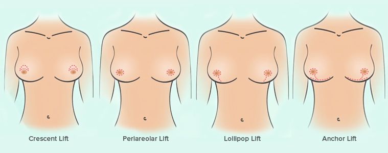 breast lift techniques