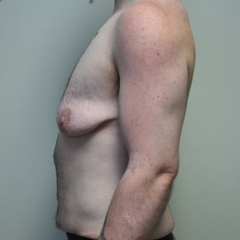 Top Surgery Before Side Photo