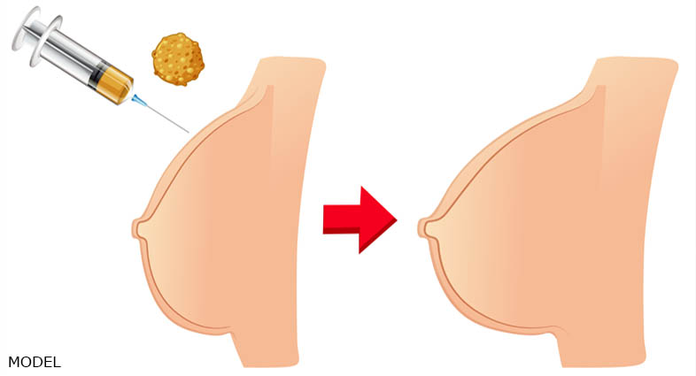 breast augmentation through fat transfer