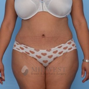  A front view after photo of patient 440 that underwent Abdominoplasty Tummy Tuck procedures at Midwest Breast & Aesthetic Surgery