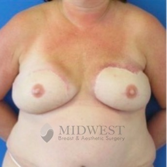  A front view after photo of patient 233 that underwent DIEP Flap Surgery procedures at Midwest Breast & Aesthetic Surgery