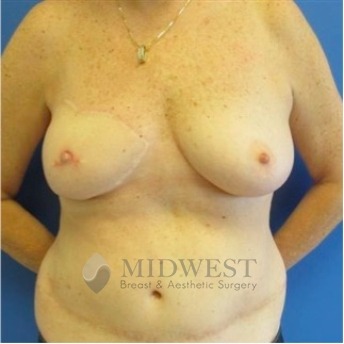  A front view after photo of patient 209 that underwent DIEP Flap Surgery procedures at Midwest Breast & Aesthetic Surgery