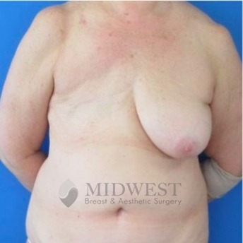  A front view before photo of patient 210 that underwent DIEP Flap Surgery procedures at Midwest Breast & Aesthetic Surgery