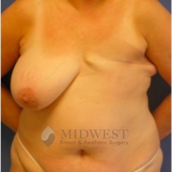  A front view before photo of patient 233 that underwent DIEP Flap Surgery procedures at Midwest Breast & Aesthetic Surgery