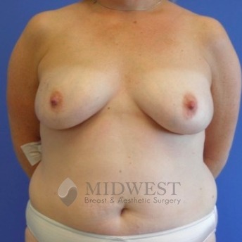  A front view before photo of patient 212 that underwent DIEP Flap Surgery procedures at Midwest Breast & Aesthetic Surgery