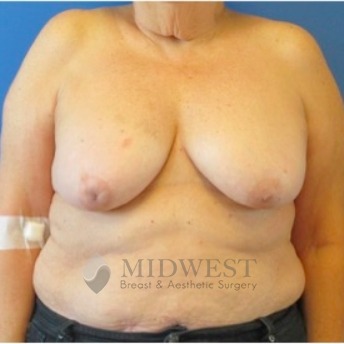  A front view before photo of patient 230 that underwent DIEP Flap Surgery procedures at Midwest Breast & Aesthetic Surgery