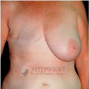  A front view before photo of patient 200 that underwent DIEP Flap Surgery procedures at Midwest Breast & Aesthetic Surgery