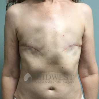 A front view after photo of patient 523 that underwent Explant Surgery:Flat Closure procedures at Midwest Breast & Aesthetic Surgery
