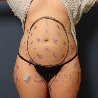  A front view before photo of patient 259 that underwent Liposuction procedures at Midwest Breast & Aesthetic Surgery