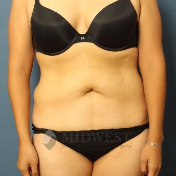  A front view before photo of patient 258 that underwent Liposuction procedures at Midwest Breast & Aesthetic Surgery