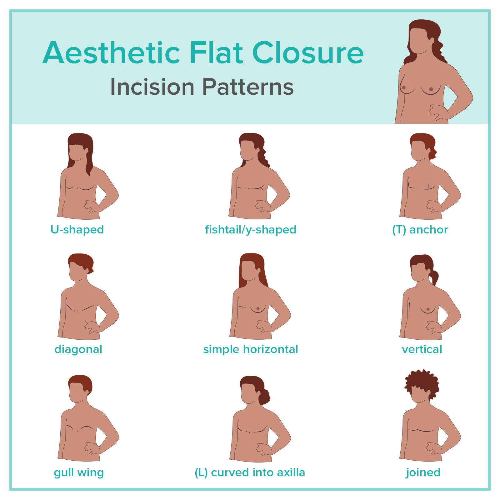 What is an Aesthetic Flat Closure