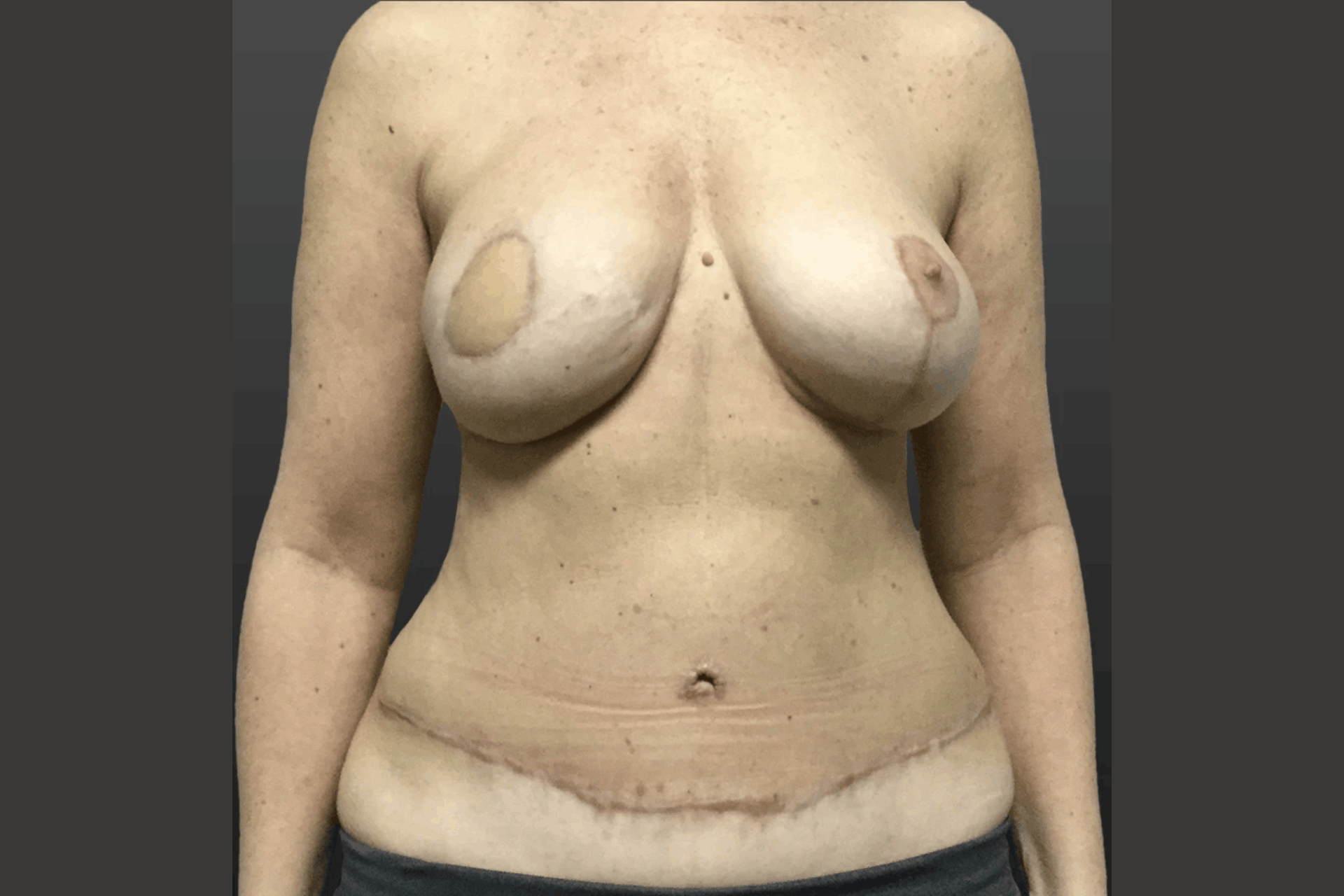 diep flap surgery guide