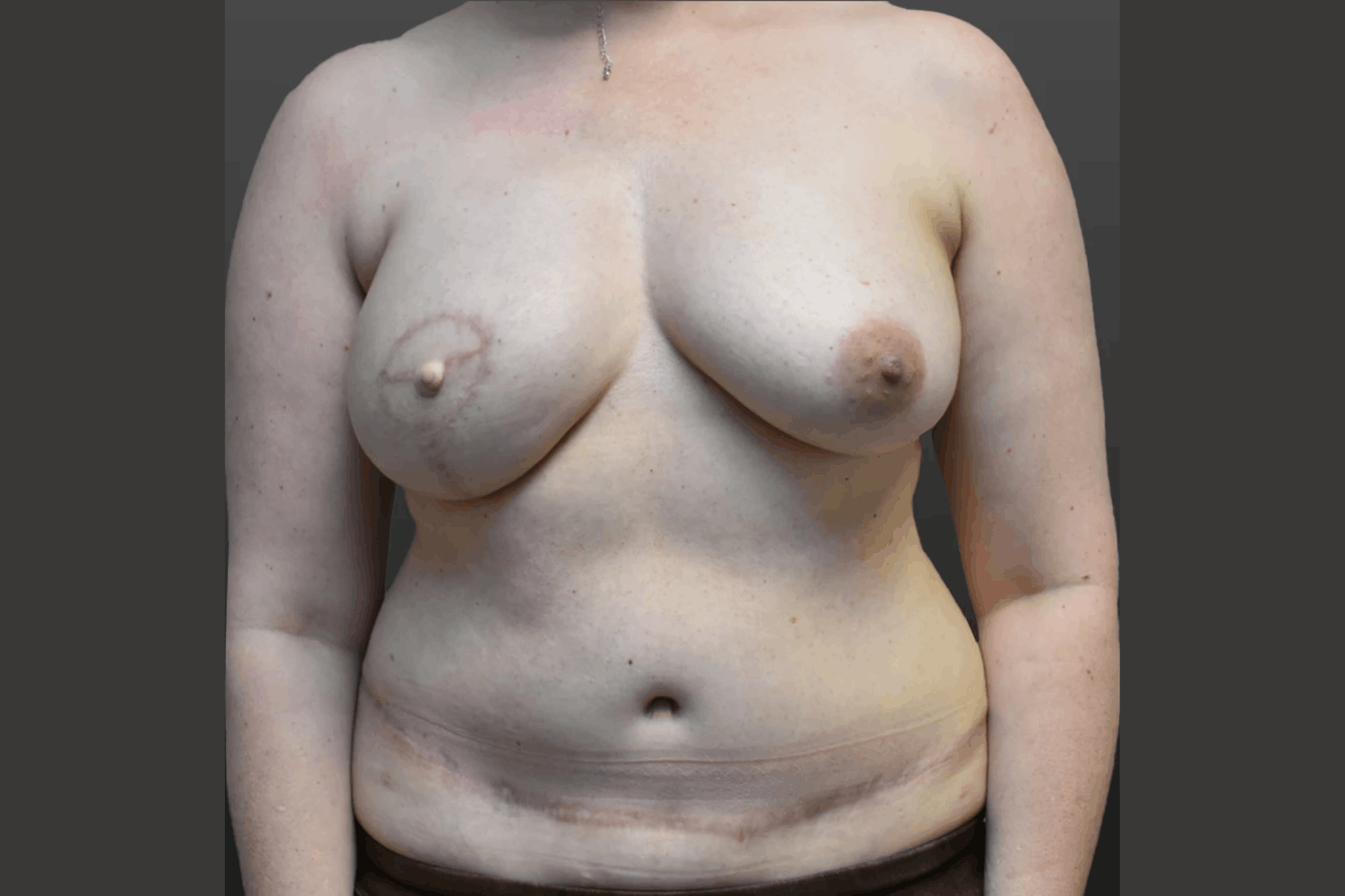 DIEP Flap After