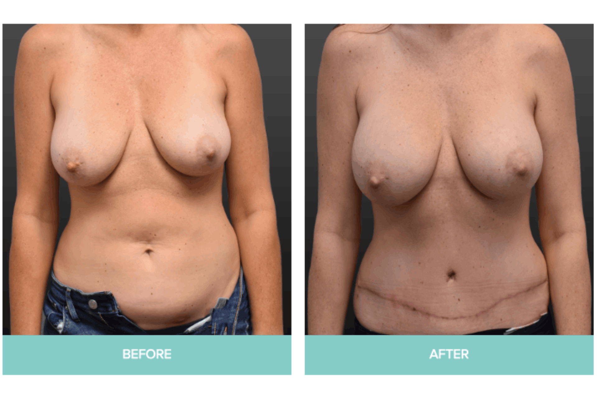 before and after breast augmentation