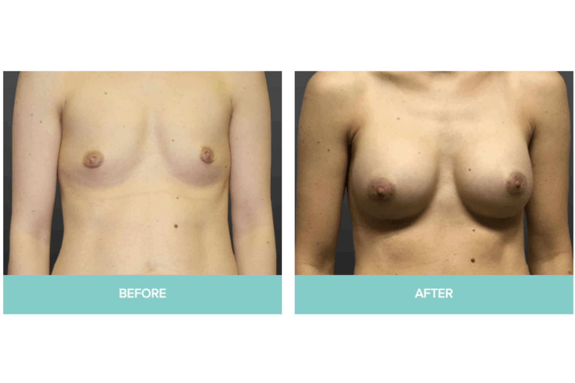 breast augmentation surgery before and after