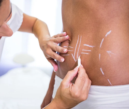 surgeon drawing lines womans abdomen liposuction cellulite removal (2) 1