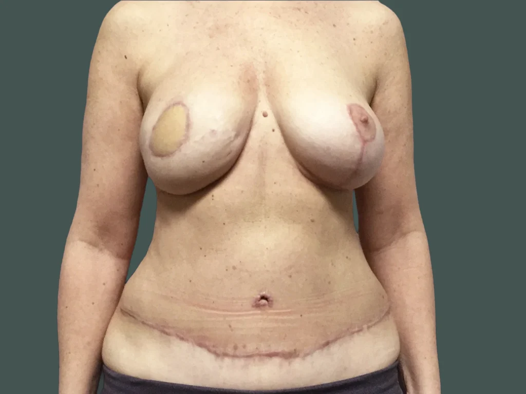 After photo for gallery case WT-427314