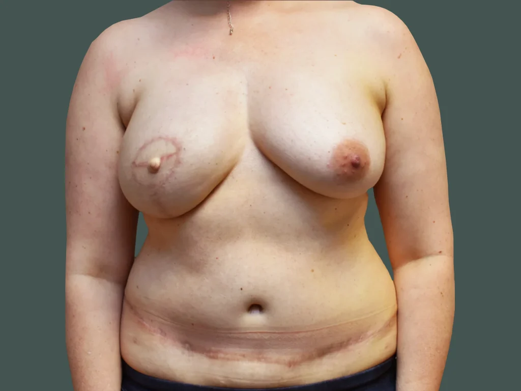 After photo for gallery case BC-190099