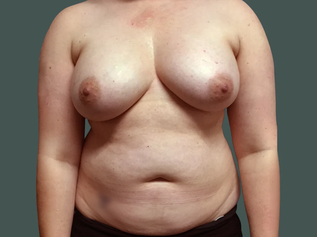 Before photo for gallery case BC-190099