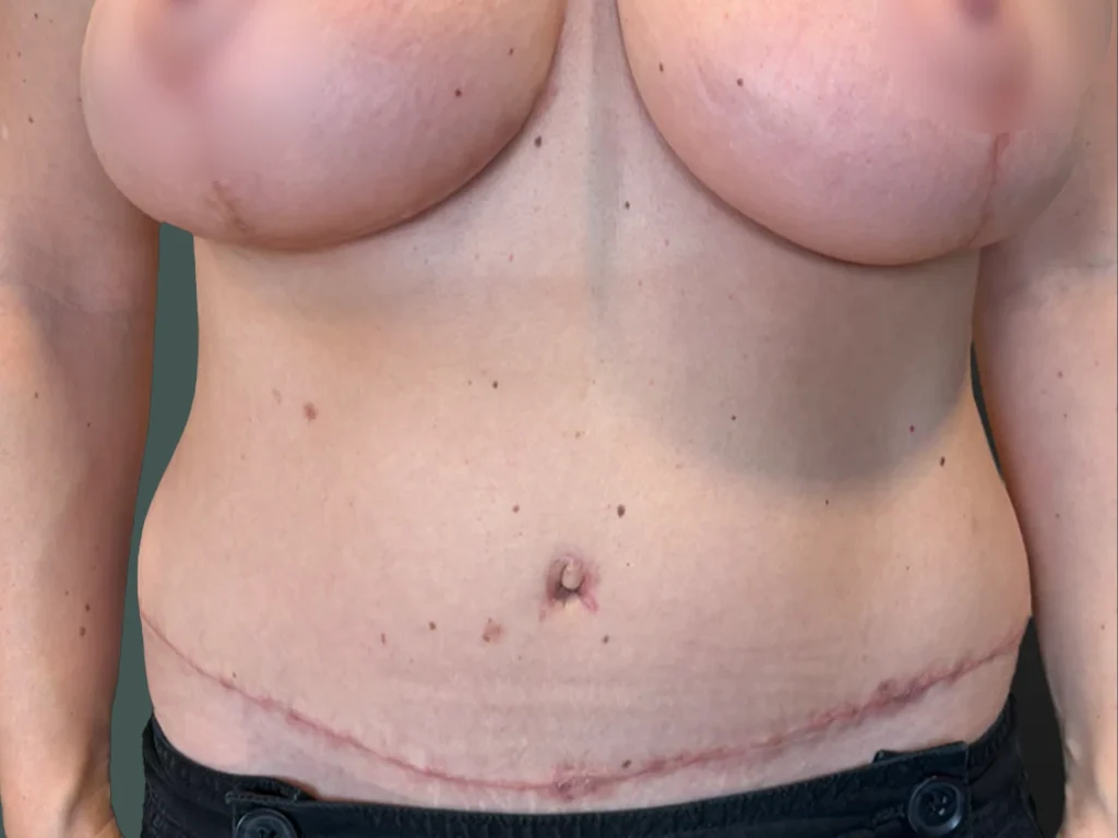 After photo for gallery case ZM-452461